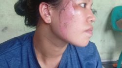 Dewi Korban Penganiayaan Brutal yang dilakukan oleh Kawan Kerjanya